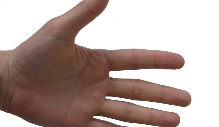 Школьницу избавили  от потных ладошек